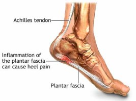 plantar-fasciitis