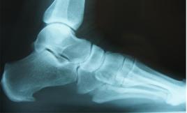 heel spur