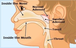 adenoids 1