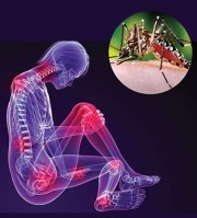 Chikungunya virus causes severe arthritic symptoms. Image courtesy of CDC