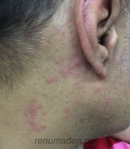 Chikungunya Face Rash Treatment Chikungunya Face Rash Treatment