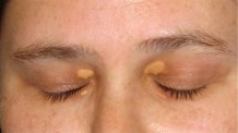 xanthelasma-fatty-white-patches-on-lids