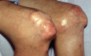 Multiple tophi both knees in advanced gout