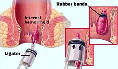 hemorrhoidal-banding