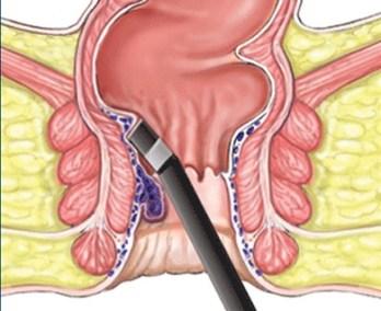 infrared-coagulation