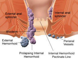 internal_and_external_hemorrhoids
