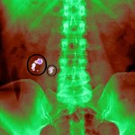 kidney-stones-x-ray-kub
