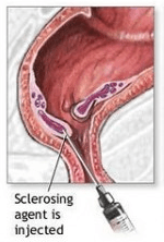 sclerotherapy
