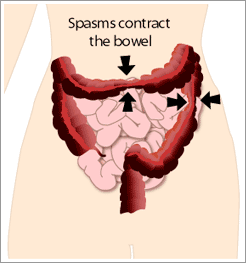 irritable_bowel_syndrome