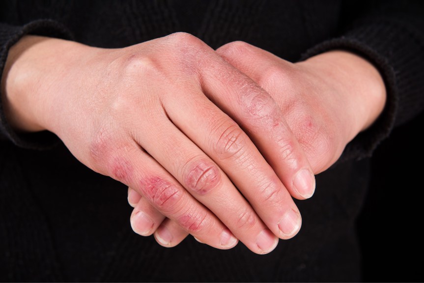 Chilblains: An Annoying Winter&nbsp;Woe