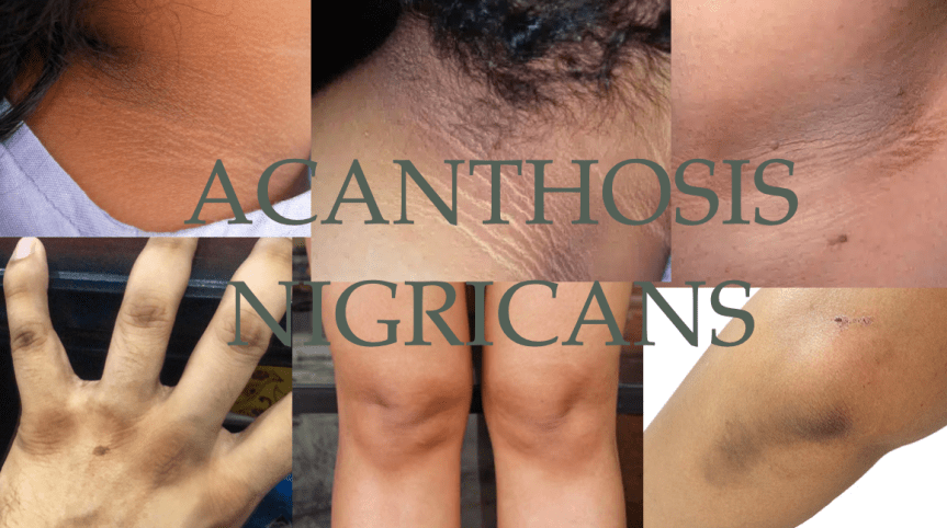 Acanthosis Nigricans: Not Just A Local Skin&nbsp;Issue…