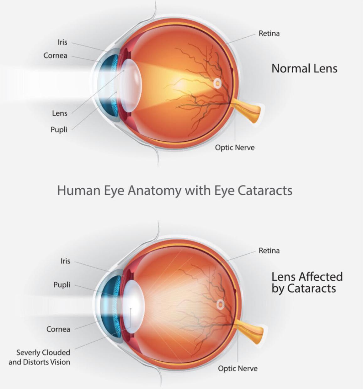 Cataracts: Can Homoeopathy Help? – Dr Renu Madan