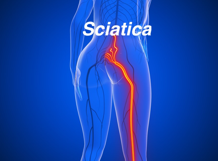 Sciatica: The Sciatic Nerve&nbsp;Pain