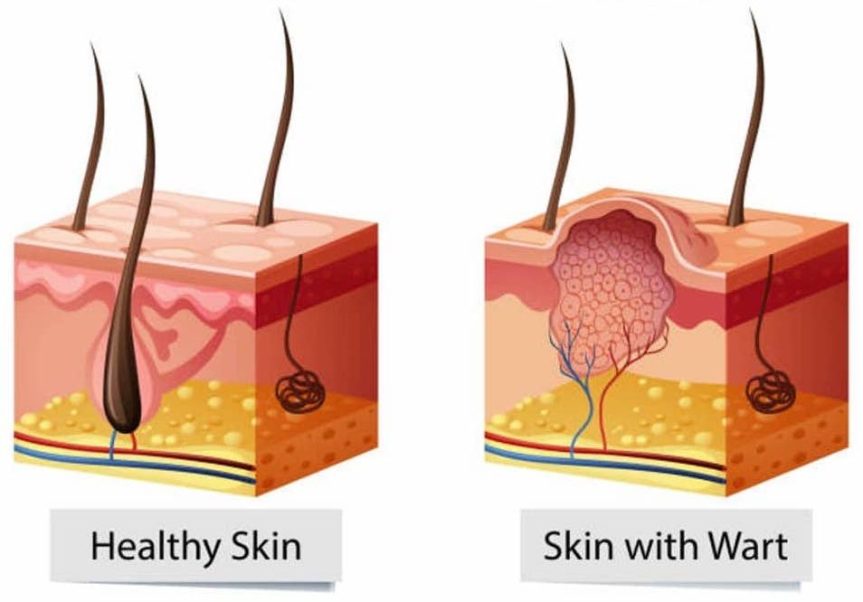 Warts – An HPV&nbsp;Infection